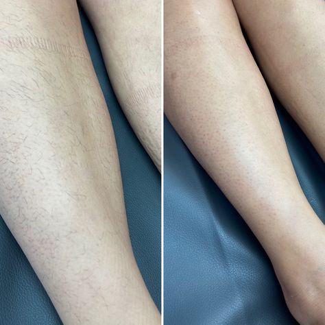 Before and afrer | wax used: harley wax ~ tea tree soft wax | instagram: beauty.is.bliss_ Painless Waxing, Hair Removal At Home, Waxing Tips, Easy Hair Removal, Waxing Services, Painless Hair Removal, At Home Hair Removal, Silky Skin, Body Waxing