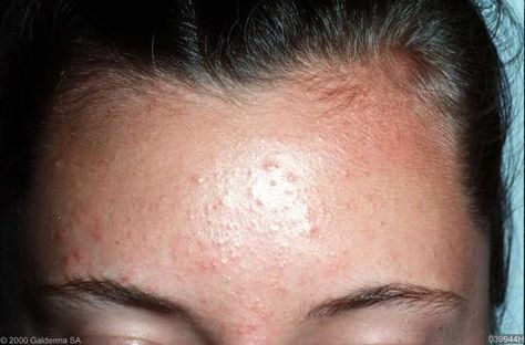 Forehead Acne, Fungal Acne, Greasy Skin, Acne Mask, Types Of Acne, Humid Weather, Anti Dandruff Shampoo, How To Get Rid Of Acne, Clear Acne