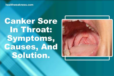 … Canker Sore In Throat: Symptoms, Causes, And Solution Read Post » Sore On Tongue Remedy, Canker Sore On Tongue, Canker Sore Causes, Canker Sore Remedy, Tongue Sores, Canker Sore, Cold Sore, What To Use, Hormonal Changes