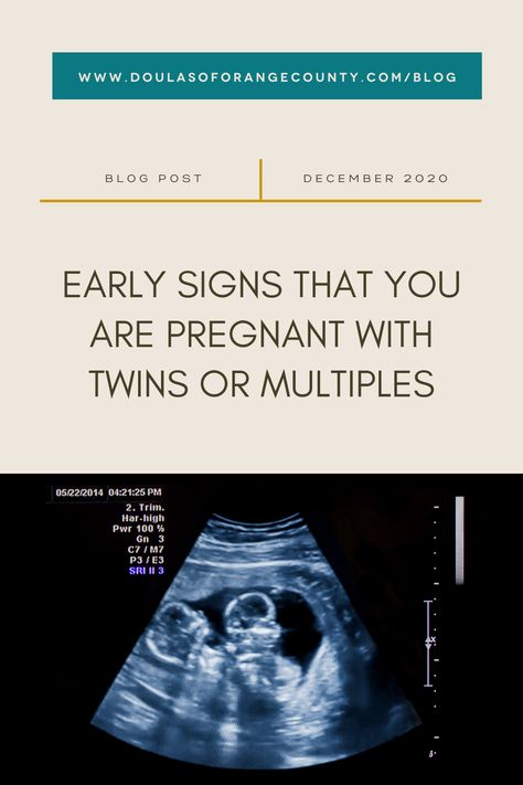 There are some early signs that you could be expecting more than one bundle of joy! Scroll through to see if you might be pregnant with multiples and for tips on soothing your symptoms. #twinmom #tripletmom #pregnancy #pregnantwithtwins #rainbowbaby #orangecountydoula #doulaorangecounty #findadoula #birthdoula #postpartumdoula Hcg Levels By Week Pregnancy, 4 Weeks Pregnant Ultrasound, Twins Ultrasound, Triplets Pregnancy, 4 Weeks Pregnant, Pregnancy Morning Sickness, Pregnant Life, Hcg Levels, Multiple Births