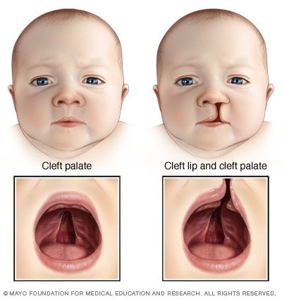 Digeorge Syndrome, Cleft Lip And Palate, Cleft Palate, Cleft Lip, Farmhouse Tile, Pediatric Nursing, Medical Knowledge, Upper Lip, Medical Illustration