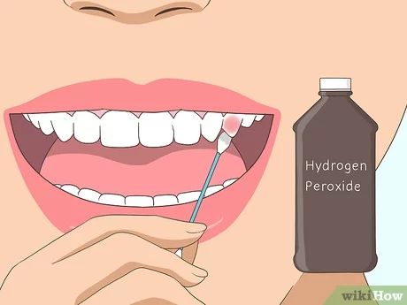 Tooth Abcess Remedy, Cavity Pain, Wisdom Teeth Pain Relief, Tooth Pain Remedies, Abscess Tooth, Severe Tooth Pain, Wisdom Teeth Pain, Tooth Pain Relief, Tooth Nerve