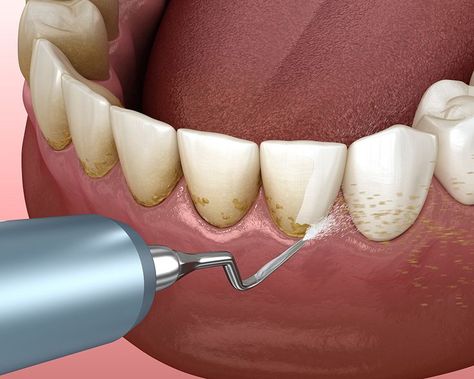 Gum Surgery, Dental Extraction, Human Teeth, Dental Emergency, Dental Cleaning, Periodontal Disease, Receding Gums, Natural Teeth Whitening, Dental Insurance