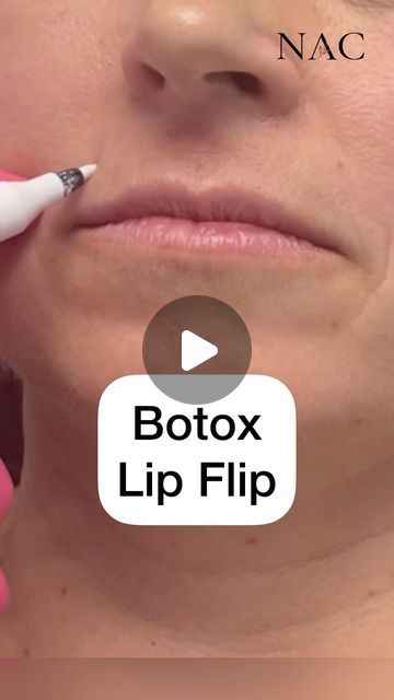 Lip Botox Natural, Lip Botox Before And After, Lip Lift Before And After, Lip Filler On Small Lips, Lip Flip Before And After, 1 Ml Lip Filler Before And After, Lip Flip Fibroblast, Lip Filler Styles, 0.5ml Lip Filler Before And After