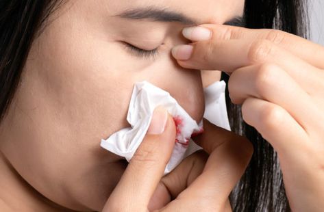 6 Ways to Stop a Nosebleed Fast – Cleveland Clinic Stop Nose Bleeds, Scab Healing, Vocal Cord Dysfunction, Saline Nasal Spray, Parts Of The Nose, Spinal Fluid, Nasal Decongestant, Nose Picking, Cold Or Allergies