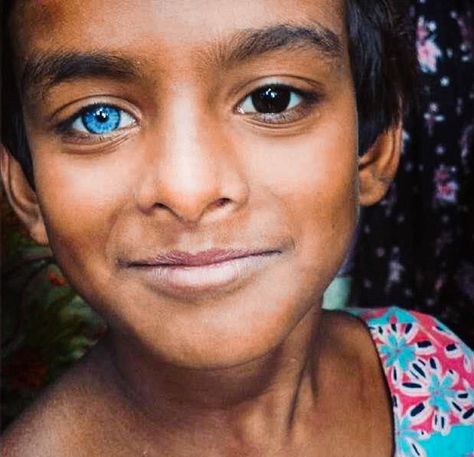 Caused by excessive or a lack of melanin, this condition is called heterochromia iridis and only around 6 out of every… by yacinestocker Waardenburg Syndrome, Heterochromia Eyes, Two Different Colored Eyes, Eye Colours, Change Your Eye Color, Different Colored Eyes, Skin Grafting, Brown Eye, Most Beautiful Eyes