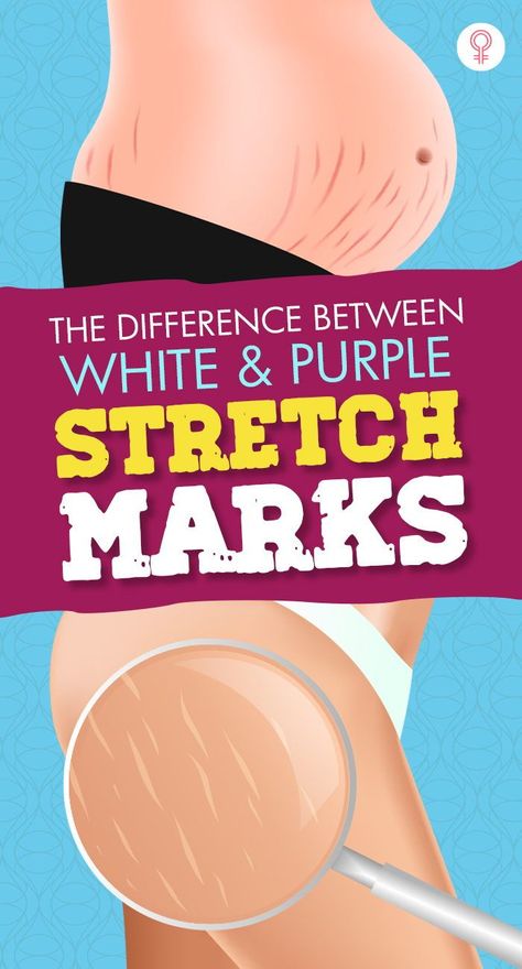 Stretch Mark Remedies, Postpartum Workouts, Marks Cream, How To Fade, Best Anti Aging Skin Care, Smooth Glowing Skin, Tips For Acne, Face Change, Stretch Mark Removal