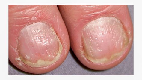 hard and rough nail surface with pitting Dents In Nails, Pitted Nails, Nail Disorders, Toenail Fungal Infection, Nail Discoloration, Nail Problems, Nail Vitamins, Nail Infection, Vitamin Deficiency