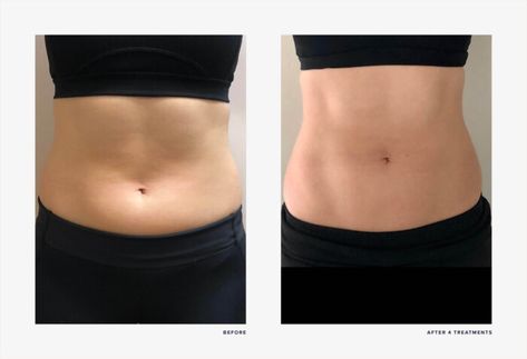 Em Sculpting Before And After, Emsculpt Before And After, Esthetic Marketing, Emsculpt Neo Before And After, Facial Lipo Before And After, Coolsculpting Before And After Stomach, Vaser Lipo Before And After, Love Handle Lipo Before And After, Ems Sculpt