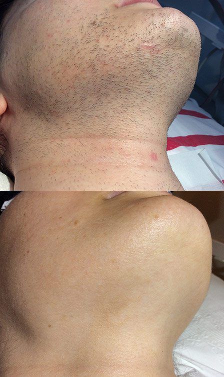 Are you looking for a permanent hair removal method? Permanence is here to help. We offer our permanent, safe, and effective hair removal for men using our unique galvanic multi-probe electrolysis method. What's more, we will permanently remove your unwanted hair from all body and facial areas. Call now! Laser Hair Removal Men, Permanent Facial Hair Removal, Electrolysis Hair Removal, Remove Unwanted Hair, Permanent Hair Removal, Underarm Hair Removal, Hair Removal For Men, At Home Hair Removal, Remove Hair