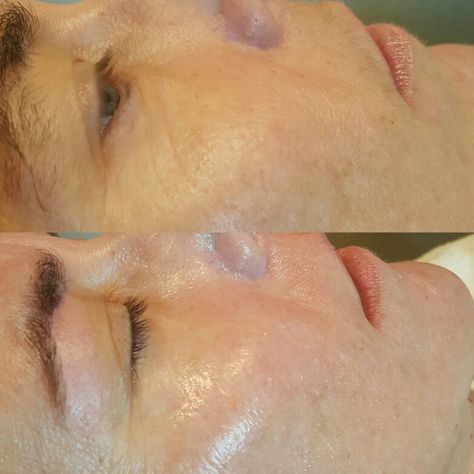 Before and after of Dermaplaning Before and after of Dermaplane Dermaplane After Care, Dermaplaning Before And After, Derma Planing, Benefits Of Dermaplaning Facial, Laser Hair Removal Face, At Home Dermaplaning, Dermaplaning Benefits Post, Waxing Studio, Permanent Facial Hair Removal