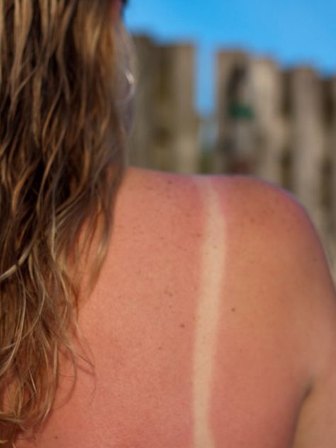 The Fastest, Most Effective Ways to Treat a Sunburn  #skincare #summerbeauty #sunburn #homeremedy Sunburn Face, 3rd Degree Burns, Heal Sunburn, Natural Remedies For Sunburn, Sunburn Skin, Sunburn Remedies, Degree Burns, Health Myths, Summer Tips