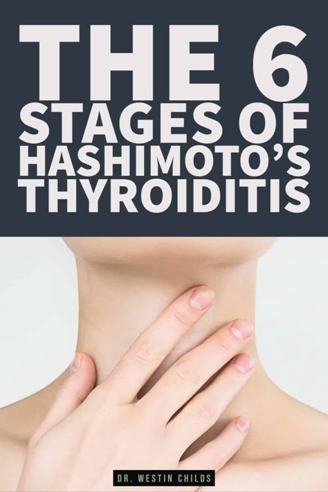 These 6 stages of Hashimoto's represent the path that all patients with autoimmune thyroid disease will experience. Hashimoto's is considered a progressive disease which means that it gets worse and worse over time. The good news is that you may be able to stop the progression of your disease if you can find out which stage you are in. The earlier the better, as the earlier stages can be treated with fewer therapies compared to later stages. Find out which stage you are in here. Hashimotos Disease Recipes, Hashimotos Symptoms, Hashimotos Disease Diet, Low Thyroid Symptoms, Low Thyroid Remedies, Thyroid Remedies, Thyroid Healing, Low Thyroid, Thyroid Symptoms