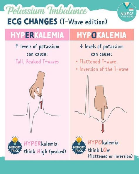 Potassium Imbalance #nursingschool #nursingstudent #study - Image Credits: Nurse In The Making Nclex Lpn, Nurse In The Making, Electrolyte Imbalance, Memory Tricks, Nursing Study Tips, Medical Assistant Student, Paramedic School, Nursing School Essential, Nursing School Motivation