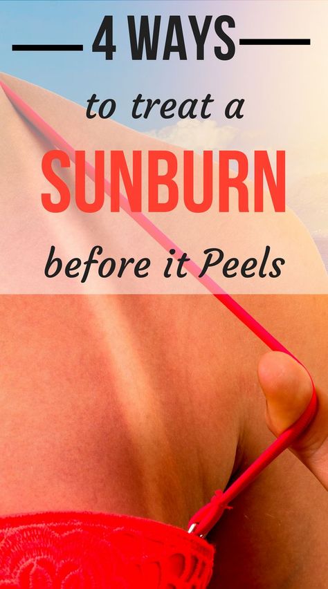 Sunburn On Face, Sunburn Face, Sunburn Blisters, How To Help Sunburn, Get Rid Of Sunburn, How To Treat Sunburn, Sunburn Peeling, Heal Sunburn, Bad Sunburn