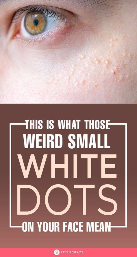 White Pimples On Face, White Bumps On Face, Small Pimples, Beauty Hacks That Actually Work, Steaming Your Face, Blind Pimple, Upper Lip Hair, Pimples Under The Skin, Exfoliating Face Scrub