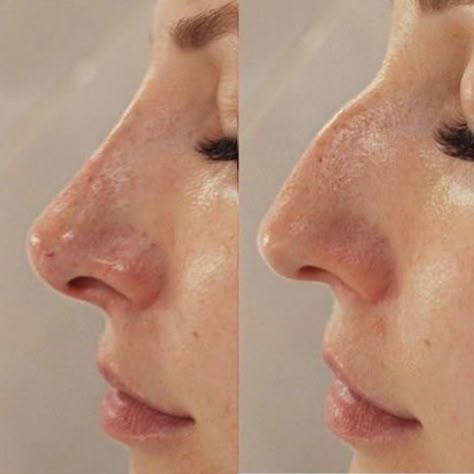 Rhinoplasty Before And After Front View, High Radix Nose, Nose Job Inspo, Droopy Nose, Bad Nose Jobs, Kylie Jenner Plastic Surgery, Nose Filler, Jaw Reduction Surgery, Nose Surgery Rhinoplasty