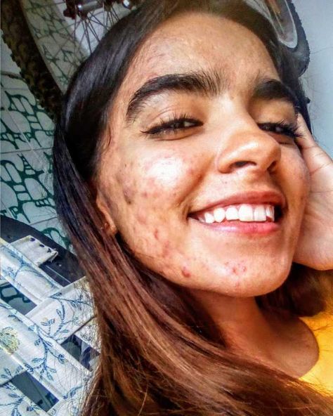 ‘How can your mom kiss you with that face?!’ My cysts were so bad they’d literally explode at any time.’: Young woman with Acne Conglobata embraces skin, gave her ‘confidence, resilience’ – Love What Matters Mom Kiss, Girl With Acne, Love What Matters, Chin Hair, Bad Acne, Pele Natural, Flot Makeup, Natural Acne Remedies, Severe Acne