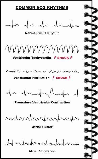 Common ECGs. Shockable--V-Fib; V-Tach Anesthesia Tech, Ekg Rhythms, Nerdy Nurse, Nurse Notes, Nursing Mnemonics, Medical Student Study, Cardiac Nursing, Nursing School Survival, Respiratory Therapy