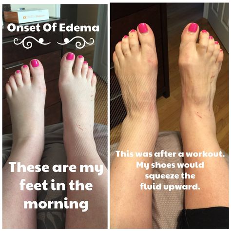 How to cope with pregnancy swelling and edema. Swelling Remedies, Pregnancy Swelling, Hangover Headache, Sunburn Peeling, Blogger Ideas, Dry Heels, Swollen Ankles, Being Pregnant, Fluid Retention