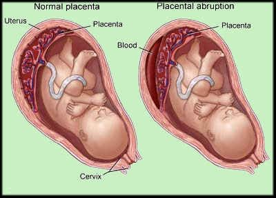 Placenta abruption (abruptio placentae) Placenta Abruption, Nurse Jackie, Nursing Study Guide, Ob Nursing, Nursing Mnemonics, Nursing Baby, Nursing Study, Nursing Notes, Nclex