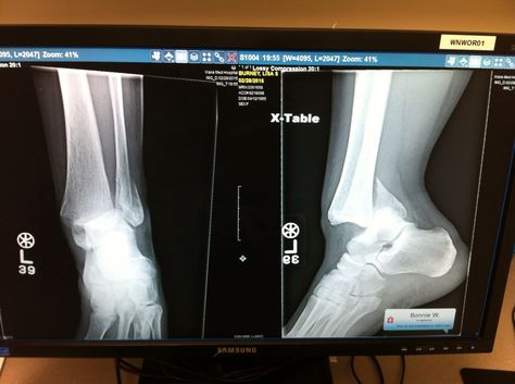 Feb. 28 x-Rays- taken at North Wake. Transferred to Wake Med for the reduction procedure and surgery. Trimalleolar Fracture, Fractured Ankle, Arte Ganesha, Ankle Fracture, Broken Foot, Broken Ankle, Surgical Tech, Xray Tech, Blur Photo Background