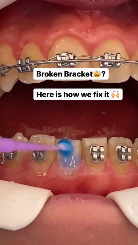 How To Stop Braces Pain, Braces Problems, Braces Aesthetic, Braces Before And After, Pink Braces, Fixed Braces, After Braces, Braces Smile, Braces Pain