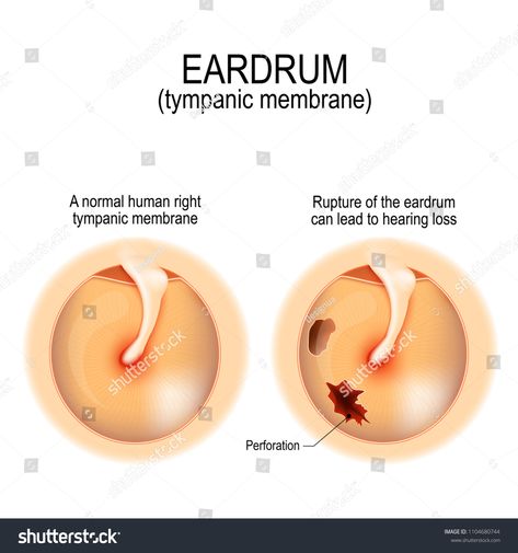 Ruptured eardrum. Anatomy of the humans eardrum. Healthy and perforated tympanic membrane. Vector illustration for medical, science, and educational use #Ad , #Ad, #humans#Healthy#perforated#Ruptured Tympanic Membrane, Vestibular System, Human Right, Medical Science, Speech Therapy, Icon Illustration, Assessment, Anatomy, Illustration Design