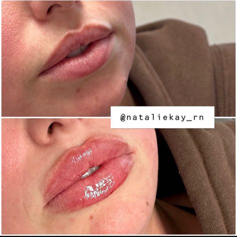 russian lip technique Lip Fillers, Being Used, Lips