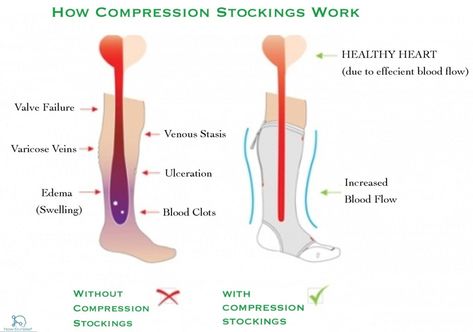 Compression Stockings: Medical uses & Contra-indications » How To Relief Compression Stockings Medical, Vein Thrombosis, Leg Compression, Body Aches, Venous Insufficiency, Swollen Legs, Water Aerobics, Scrub Life, Compression Stockings