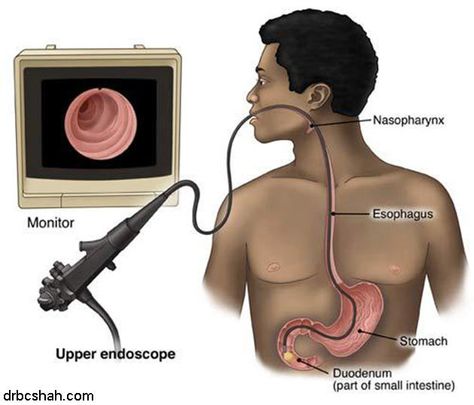 Upper Endoscopy Upper Endoscopy Procedure, Endoscopy Procedure, Clinical Rotations, Integumentary System, Interventional Radiology, Heart Rhythms, Dirty Thirty, Radiology, Web Hosting Services