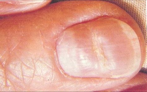 Fingernails and what they reveal Finger Nails Health, Dents In Nails, Fingernail Health, Nail Ridges, Wrinkles Hands, Nail Problems, Top Treatments, Nail Infection, Fungal Nail