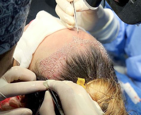 Figures released by the International Society of Hair Restoration Surgery (ISHRS) in 2022 show that there’s still a big gap between men and women when it comes to hair transplant surgery. Approximately 87% of hair transplant procedures performed by ISHRS members were carried out on male clients, leaving women to make up just 13% of the total. Hair Transplant Procedure, Hair Transplant Surgery, Hair Clinic, Hair Restoration, Hair Transplant, Latest Hairstyles, Hair Care Tips, Surgery, Need To Know