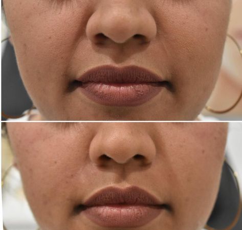 Dr. K on Instagram: “Before and after filler! Here I used Voluma to soften the nasolabial folds🤗” Nasolabial Fold Filler, Skin Anatomy, Dr K, Nasolabial Folds, Glo Up, Educational Videos, Instagram Accounts, Anatomy, Self Care