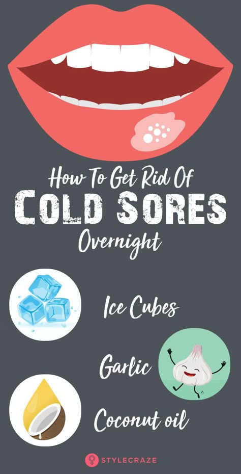 Cold Sore Remedy Fast, Cold Sore Remedy Overnight, Fever Blister Remedy, Cold Sore Lip, Cold Sore Remedy, Blister Remedies, Cold Sore Prevention, Canker Sore Remedy, Oils For Colds