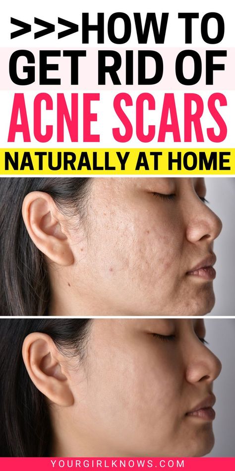 Are you struggling with acne scars? Don't worry, we have the solution. These tips will help clear up your skin and get rid of those pesky scars for good. So what are you waiting for? Start following these steps today! What To Use For Acne Scarring, Home Remedies For Acne And Scars, Remove Acne Scarring, Getting Rid Of Acne Marks, How To Remove Acne Scar Marks, Diy Acne Scar Remover, How To Clear Acne Scarring, How To Heal Acne Scarring, How To Get Rid Of Scars From Acne