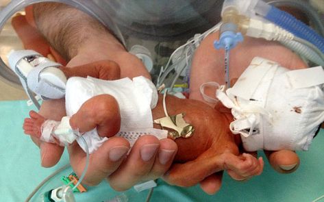 Life Support Machine, Neonatal Intensive Care Unit, Miracle Baby, Life Is Precious, Give Birth, Premature Baby, Planned Parenthood, Baby Born, Intensive Care