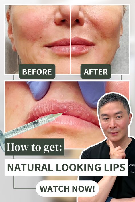 Whether you seek subtle enhancements or more noticeable changes, the right technique can make all the difference!

#hyaluronicacid #hyaluronicacidfiller #dermalfillers #dermalfiller #lipfiller #lipfillerinjections #lipfillerbeforeandafter #lipfillertechnique #lipinjections #lipfillertransformation #naturallipfiller
#liptreatment Natural Lip Fillers Before And After, Subtle Lip Filler Before And After, Subtle Lip Filler, Lip Filler Injection, Filler Techniques, Lip Filler Technique, Filler Injection, Hyaluronic Acid Fillers, Injectables Fillers