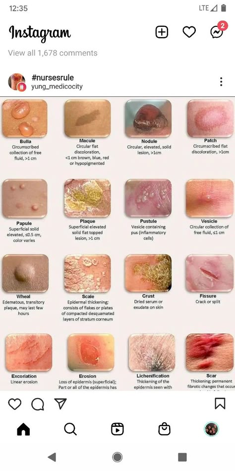 Skin Diseases Pictures, Skin Conditions Pictures, Wound Care Nursing, Skin Lesions, Basic Anatomy, Nurse Study, Medical Notes, Basic Anatomy And Physiology, Nurse Study Notes