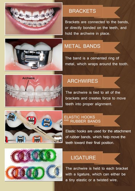 Common #braces and orthodontic terms and what they mean #BozemanSmiles #BozemanMontana Brace Tips, Braces Hacks, Invisible Teeth Braces, Scarborough Toronto, Zoom Whitening, Braces Bands, Scarborough Ontario, Dental Assistant Study, Types Of Braces