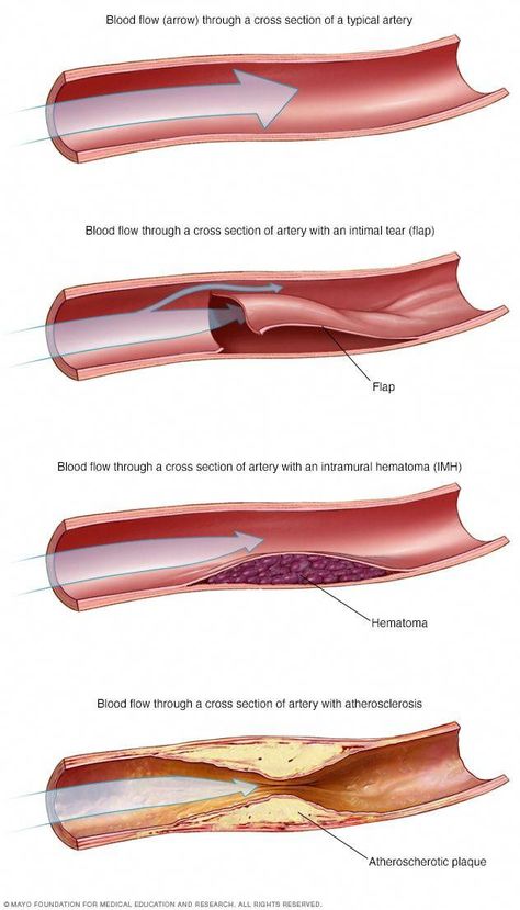 Medicine Art, Acute Coronary Syndrome, Coronary Artery, Heart Anatomy, Biology Art, Medical Emergency, Blood Sugar Diet, Coronary Arteries, Healthy Diet Tips