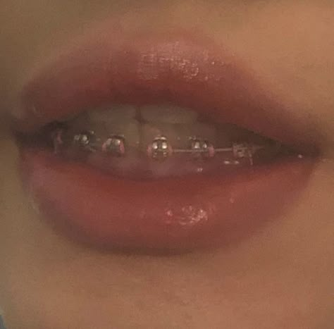 Bottom Braces, Cute Teeth Aesthetic, Braces Smile Aesthetic, Bottom Braces Only, Braces Aethstetic, Bottom Teeth Braces, Brackets Aesthetic, Braces Aesthetic Power Chain, Grilz Teeth Girl