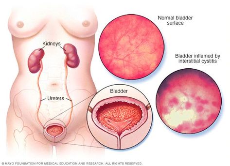 Bladder-Rebalancing Painful Bladder Syndrome, Simple Stretches, Throbbing Headache, Urinary Tract Health, Urinary System, Urinary Health, Health Podcast, Bladder Control, Frosé