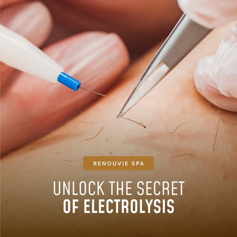 Electrolysis at Renouvie Spa goes beyond just removing unwanted hair; it's a technology endorsed and FDA-approved, delivering reliable and lasting results. This safe and effective process uses electrical currents to destroy hair follicles, preventing hair regrowth. Discover confidence in every session and bid farewell to unwanted hair permanently. 💖🔗 . . . #HolisticWellness #RenewYourLove #WellnessEveryDay #DaySpa #WellnessJourney #TopSpa #RenouvieSpa #WellnessCenter #wellness #SkinHealth #... Electrolysis Hair Removal The Face, Ulike Ipl Hair Removal, Philips Laser Hair Removal, Electrolysis Hair Removal, Ipl Laser Hair Removal, Unwanted Hair Permanently, Laser & Ipl Hair Removal Devices, Hair Follicles, Unwanted Hair Removal