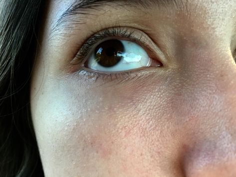 [Skin Concerns] bumpy and rough skin under eyes. And ideas as to what it might be? Rough Skin On Face, Dermatologist Recommended Skincare, Under Eyes, Hair Removal Cream, Rough Skin, Dermatologist Recommended, Moisturizing Lotions, Skin Concern, Dull Skin