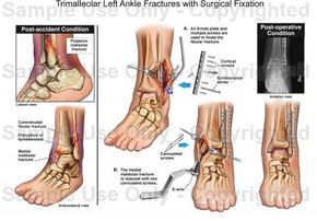 Trimalleolar Left Ankle Fractures with Surgical Fixation.  Why I'm sitting in a rehab center.  I need to heal fast to finish closing in my little home before the weather changes! Ankle Fracture Recovery, Breast Reduction Surgery, Ankle Fracture, Anatomy Illustration, Drawing Anatomy, Broken Ankle, Reduction Surgery, Rehab Center, Human Anatomy Drawing