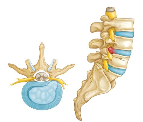 Lumbar Disc, Intervertebral Disc, Bulging Disc, Hip Problems, Disk Herniation, Spinal Nerve, Hip Flexor Stretch, Psoas Muscle, Spine Health