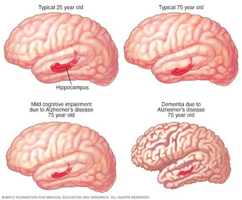 Mild cognitive impairment - Symptoms and causes Cognitive Impairment, Brain Memory, Brain Structure, Mayo Clinic, Medical Education, Alzheimers, Womens Health, Disease, Brain