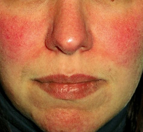 Survey Shows Facial Redness Takes Emotional Toll | Rosacea.org Skin Rash On Face, Redness Remedy, Rash On Face, Low Stomach Acid, Healing Waters, Skin Redness, Stomach Acid, Sensitive Skin Care, Skin Conditions