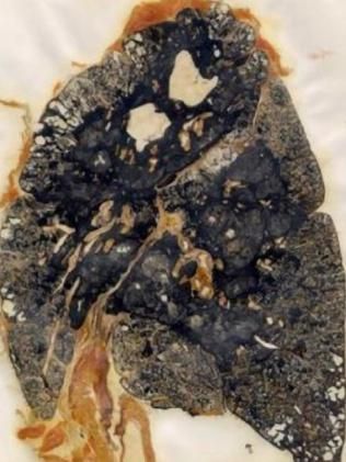 Lungs Drawing, Black Lungs, Crystal Makeup, Lung Disease, Smoothie Recipes Healthy, Lungs, Vegan Eating, Natural Food, Cavities